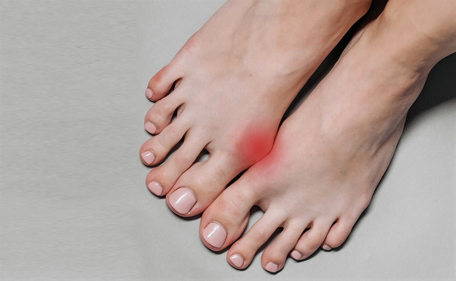 بترین راه درمان انحراف انگشت شست پا در خانه