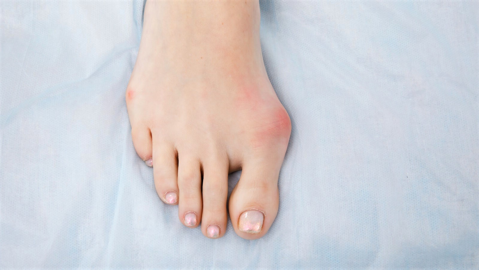 درمان انحراف انگشت شست پا در خانه