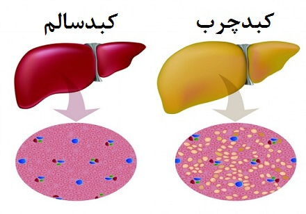 کبد چرب